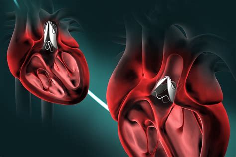 Global Cardiac Prosthetic Devices Market $15.2 Billion by 2031