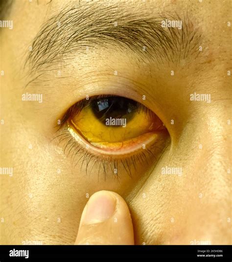 Deep jaundice of eye in Asian male patient. Yellowish discoloration of ...