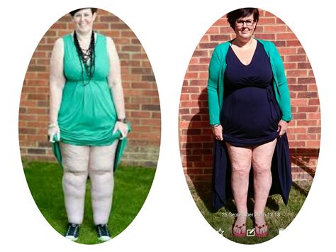 Claire Tickle’s Painful 10 Stone Lipoedema Legs Are Now "Pain-Free And ...