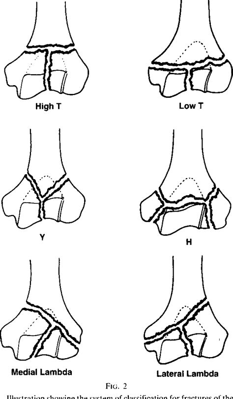 Complex fractures of the distal part of the humerus and associated ...