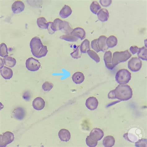 Plasmodium Falciparum Under Microscope