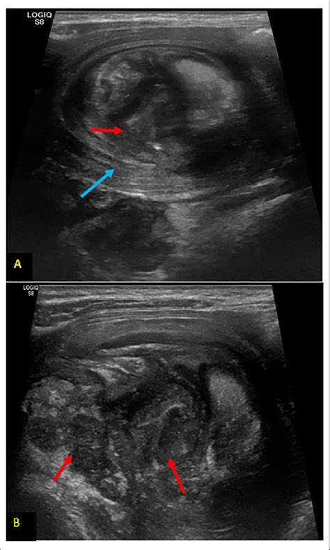 Ultrasound images (A, B) showing an epigastric mass of 4x6cm with ...