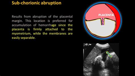 Placental Hemorrhage Ultrasound