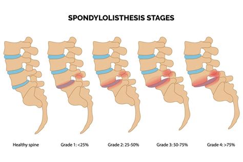 Spondylolisthesis - ONZ Spine