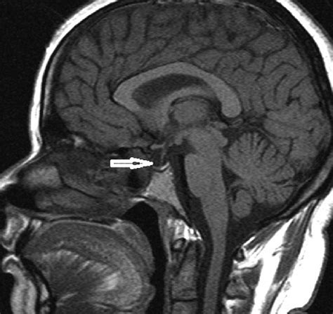 Magnetic resonance image of brain sagittal view showing empty sella ...