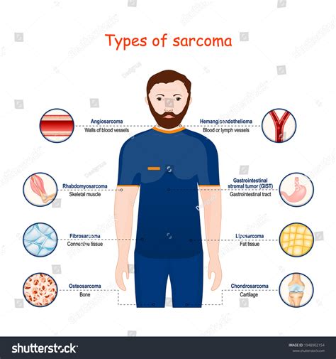 Sarcoma Types Malignant Tumor Cancer That Stock Vector (Royalty Free ...