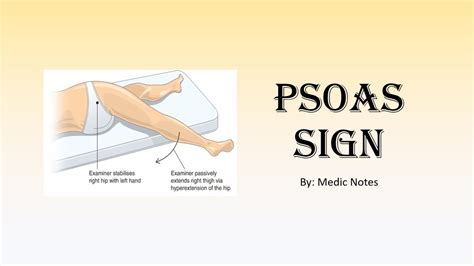 Psoas sign - how to elicit, causes, mechanism - YouTube