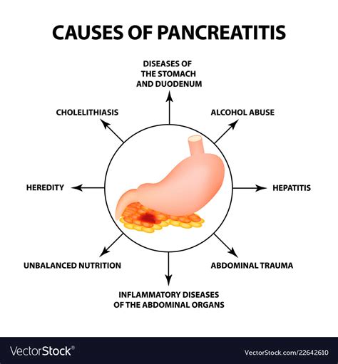 Causes of pancreatitis the structure Royalty Free Vector