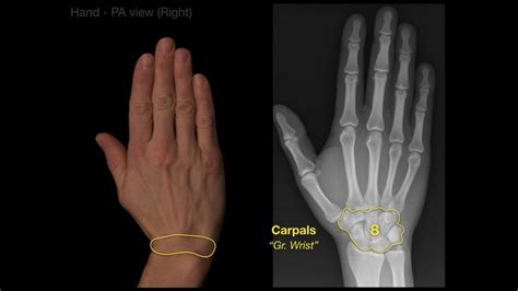 Bones Of The Hand X Ray