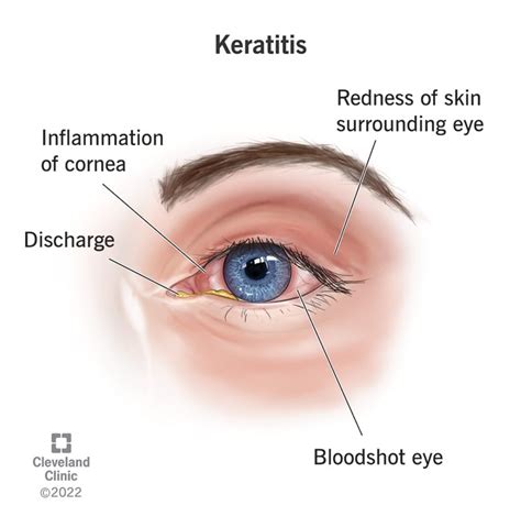 Keratitis: Types, Symptoms & Treatment