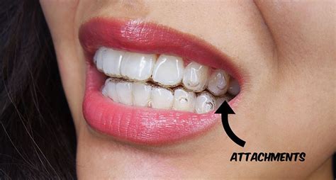 Everything You Need to Know About Invisalign Attachments