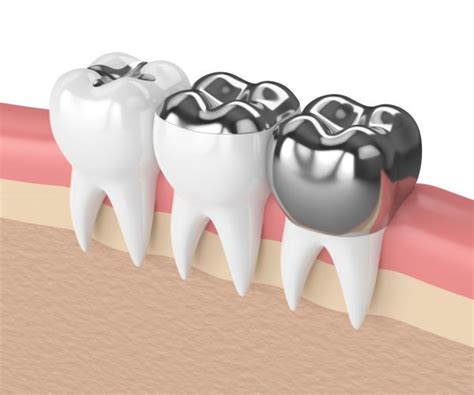 Pros and Cons of Amalgam Fillings - GK Dental PC Everett Massachusetts