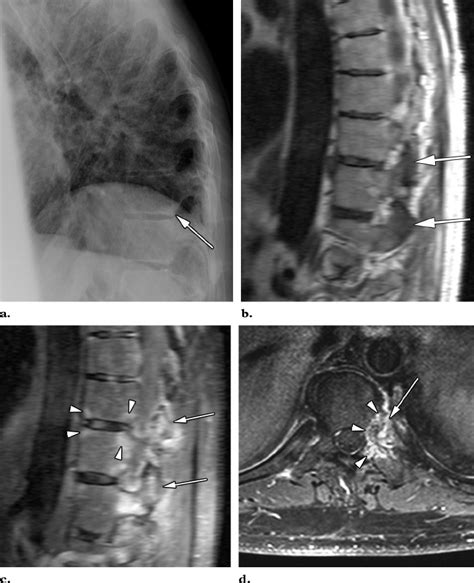 Arthritis of the zygapophyseal joints in a 32-year-old patient with ...