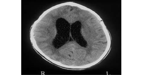 Mucopolysaccharidosis - www.medicoapps.org