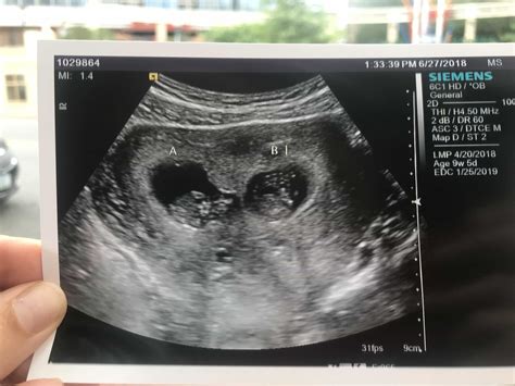 9 Week Ultrasound Twins