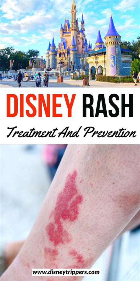 How To Treat And Prevent Disney Rash - Disney Trippers | Disney rash ...