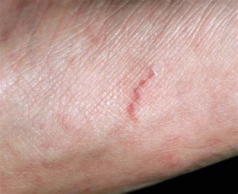 Scabies - Signs, Symptoms, OTC Treatment & Home Remedies