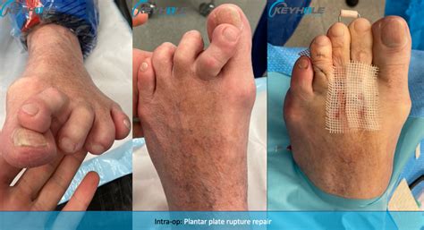 Plantar Plate Tear - Perth Podiatric Surgery