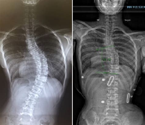 LOC Scoliosis Treatment Brace