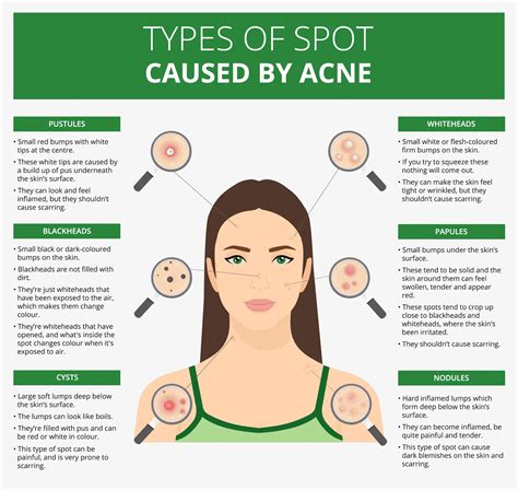 Understanding The Causes Of Acne - Ask The Nurse Expert