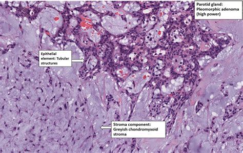 Salivary Gland – Pleomorphic Adenoma – NUS Pathweb :: NUS Pathweb