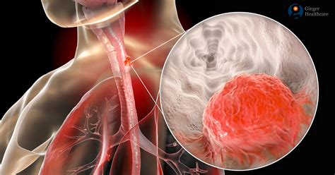 Esophagus Cancer: Causes, Symptoms, Diagnosis & Treatment options