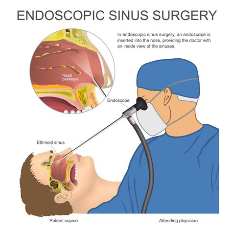 Functional Endoscopic Sinus Surgery - ENT Florida