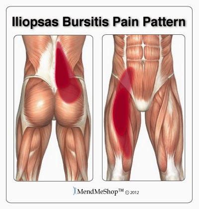 Iliopsoas Syndrome: