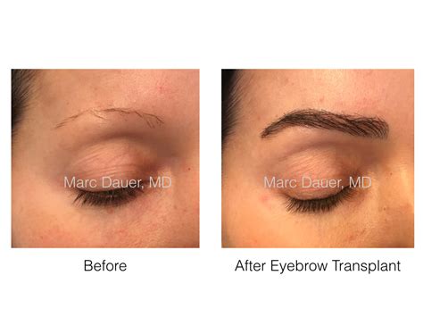 Eyebrow Restoration Los Angeles, Eyebrow Transplant Procedure