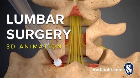 Lumbar Surgery - Laminectomy - 3D Medical Animation - YouTube