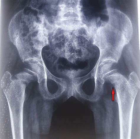 Bilateral Neck of Femur Fracture in a Child With Underlying Vitamin D ...