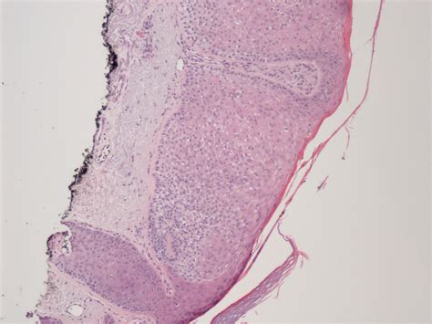 trichilemmoma10x | Trichilemmoma 10x John H. Irlam DO Univer… | Flickr