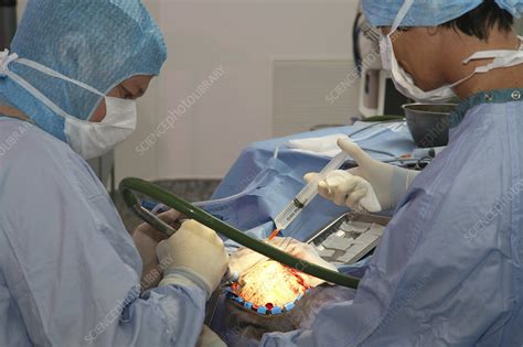 Meningioma surgery - Stock Image - C004/0783 - Science Photo Library