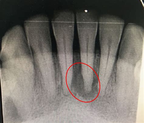 Periapical Abscess Radiograph