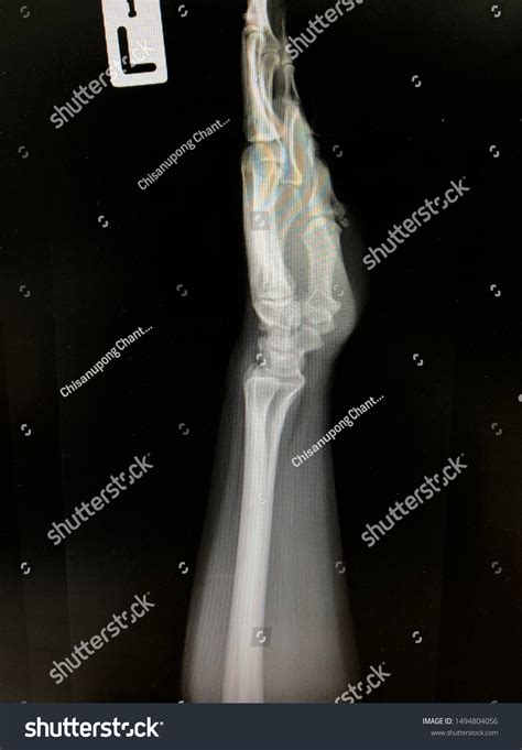 Normal Wrist X Ray