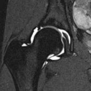 How can a hip MRI help a diagnosis? | Wake Radiology