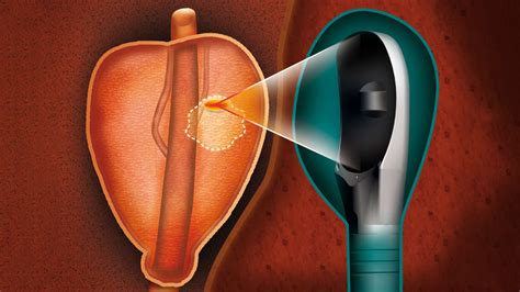 Focal High-Intensity Focused Ultrasound Ablation for Intermediate-Risk ...