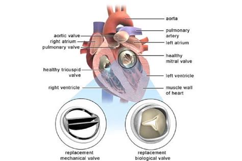 Ce proteză valvulară este cea mai potrivită pentru mine? - Medic primar ...