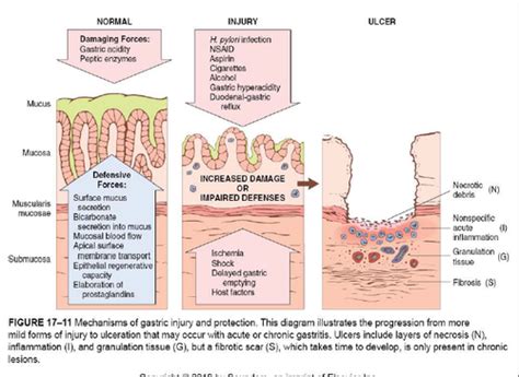 Curling Vs Cushing Ulcer - Pathogenesis Of Diseases Of The Stomach Ppt ...