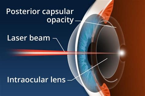 What Is a Posterior Capsulotomy and How Does It Work? - The Eye News