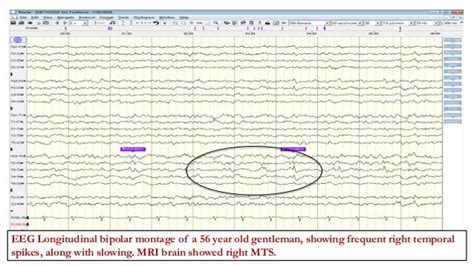 Abnormal focal eeg patterns