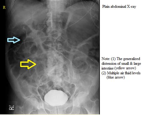 Ileus x ray - wikidoc