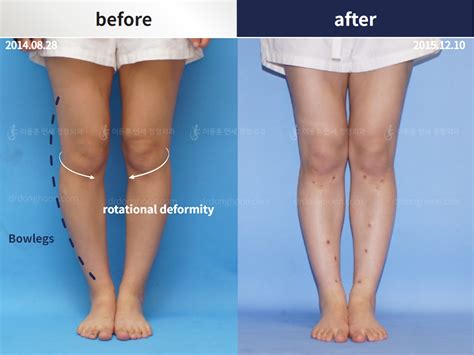 This patient treated bowlegs and rotational deformity at the same time ...