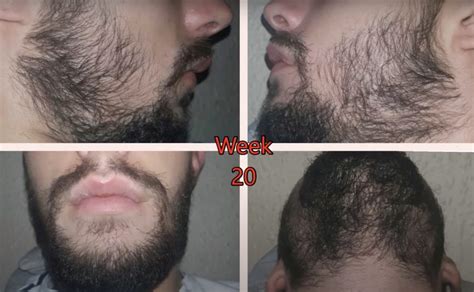 Minoxidil Beard Growth: Before & After, Usage, Side Effects