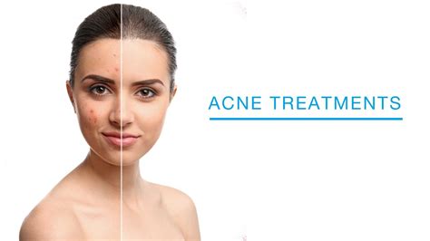 Acne Treatment at Laser + Skin Institute, Chatam, NJ