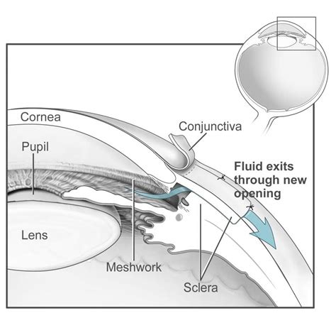 Glaucoma surgery - Wikipedia