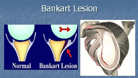 Bankart Lesion