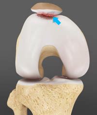 Chondromalacia Patella Beaverton | Knee Pain | Patellofemoral Pain Portland