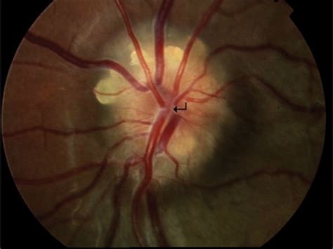 Surface and buried optic nerve head drusen. The disc is elevated and ...