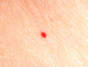 What Causes Little Red Dot on the Skin? | New Health Advisor